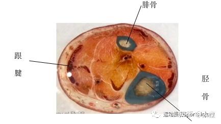 解剖列车筋膜链高清图图片