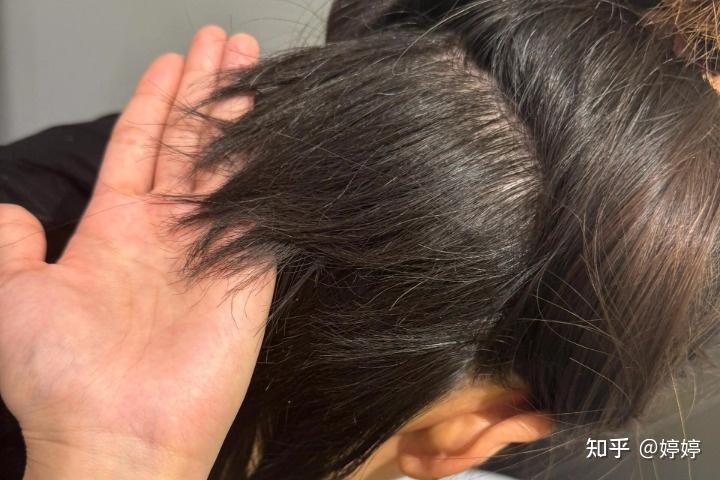 植发怕什么(植发期间需要注意什么)