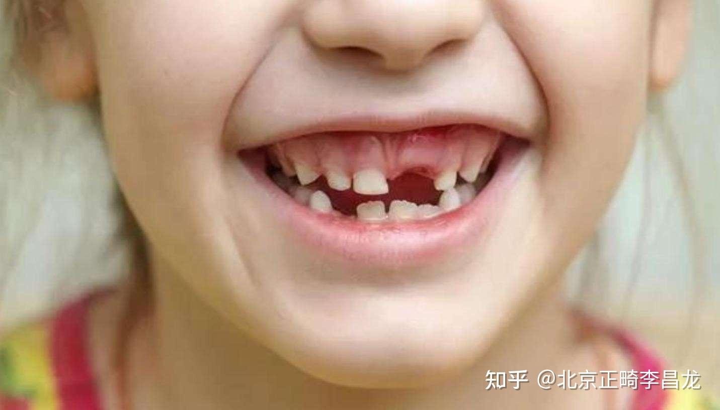 深圳儿童龋齿的预防措施有哪些_深圳爱康健口腔医院(官网)