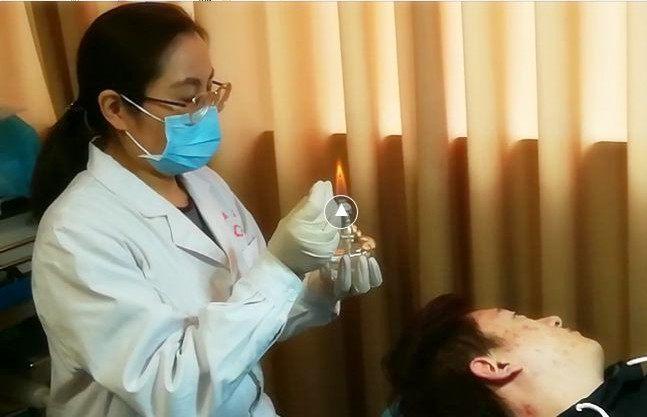 痤疮青春痘的克星火针疗法