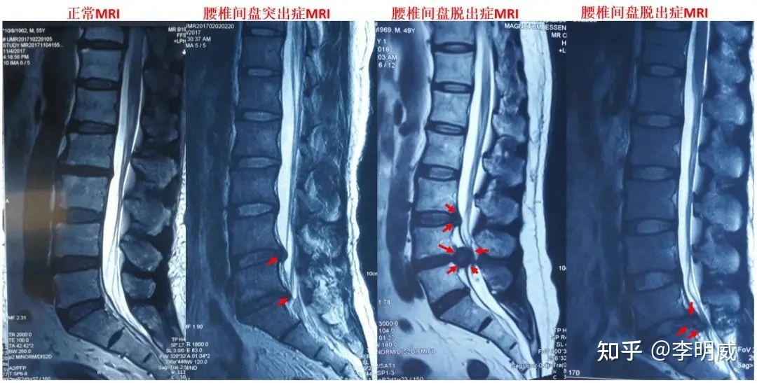 李明威年紀輕輕就腰間盤突出帶你拯救受傷的腰間盤