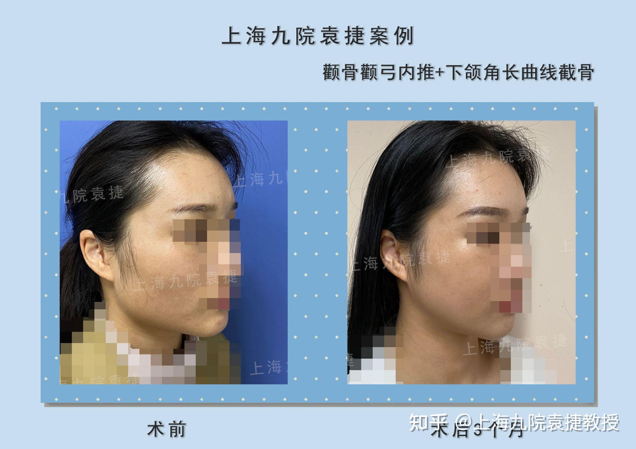 韩国gng医院下颌角磨骨怎么样?GNG下颌角截骨后脸型缩小明显,颌面对比照-8682赴韩整形网