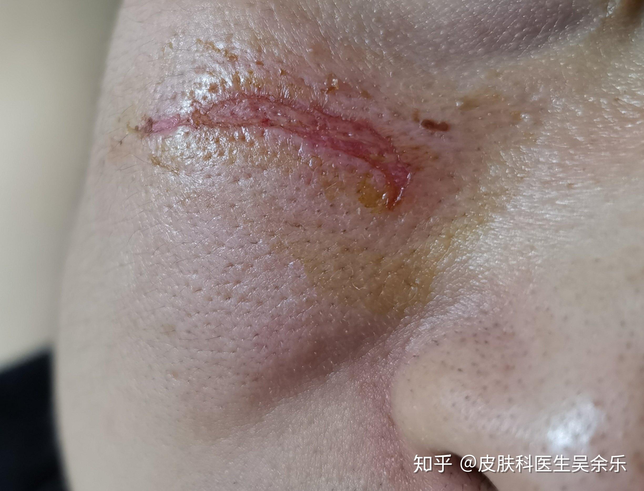 不留疤痕?现在这种情况日常怎么护理?现在可以使用祛疤贴吗?