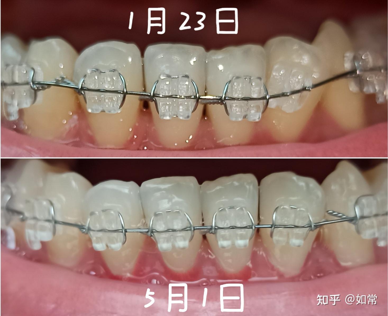 正畸八字结扎图片