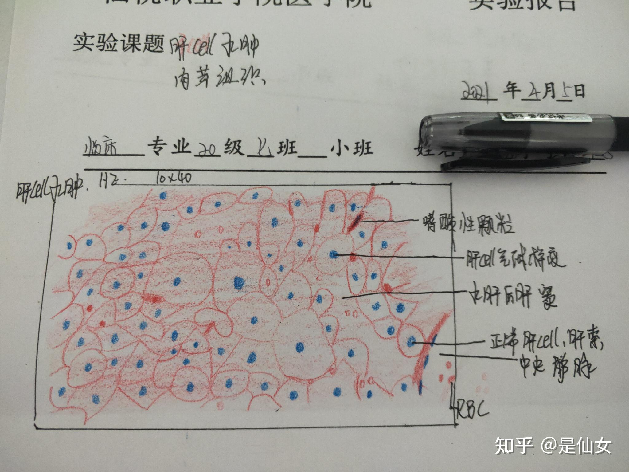 肝细胞水肿红蓝铅笔图图片