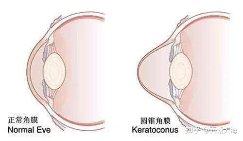 一,角膜曲率,指角膜的彎曲程度,理想的角膜彎曲面應該是均勻一致的