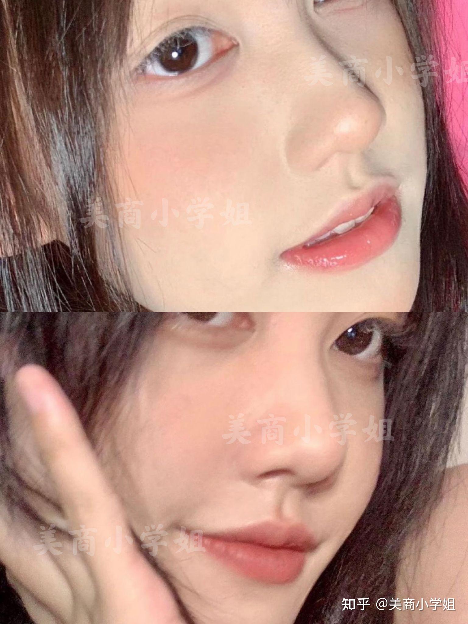 云南华美美莱美容医院玻尿酸隆鼻怎么样_恢复过程_效果如何_那一天的风会说话整形日记12.7_新氧美容整形