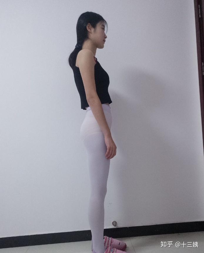 真实案例腰腹吸脂大半年了来分享下吸脂的过程吧