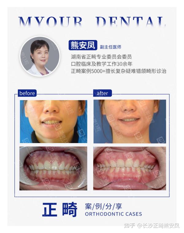 拔牙正畸能往回内收多少毫米？ - 知乎