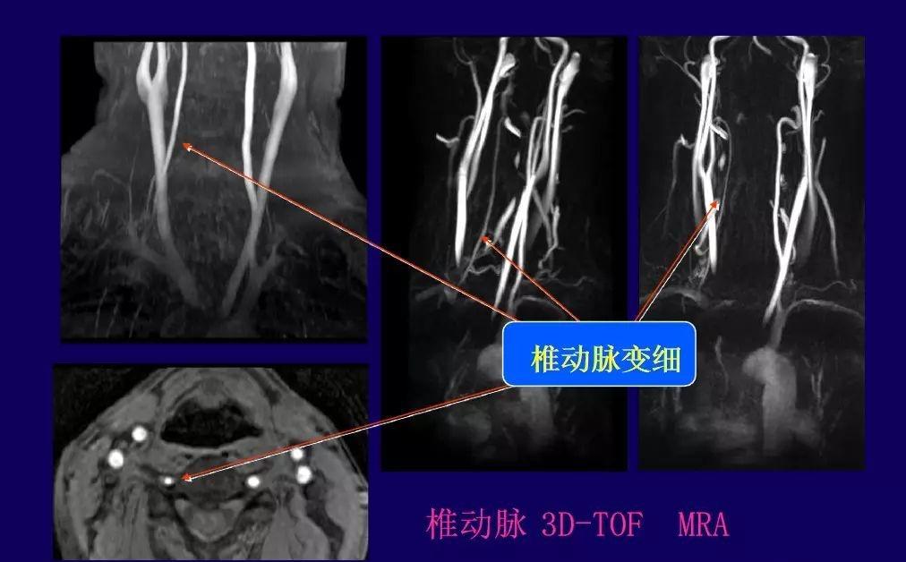 經顱多普勒超聲檢查( tcd )椎動脈彩色多普勒超聲血流顯像( cdfi )