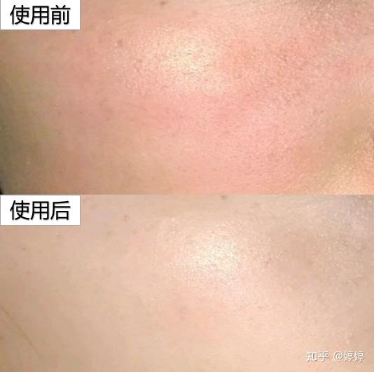 我的皮肤属于油敏肌,比较容易泛红,痘痘闭口也不间断,皮肤状态不佳,很