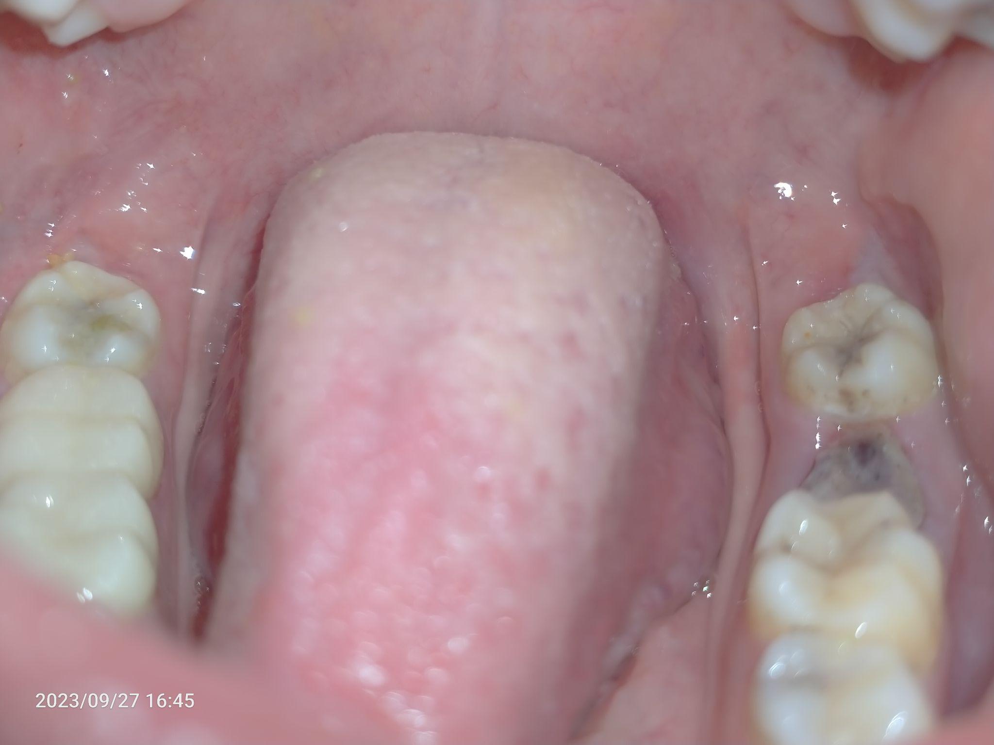 拔牙经历及拔牙后血凝块的变化