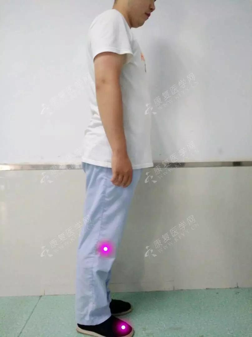 如何通过姿势评估前表线和筋膜问题？（附手法治疗） - 知乎