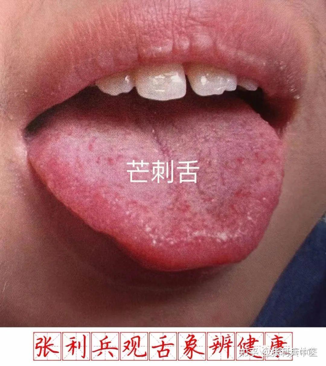 舌头上长乳头状瘤图片,舌头长肉芽 - 伤感说说吧