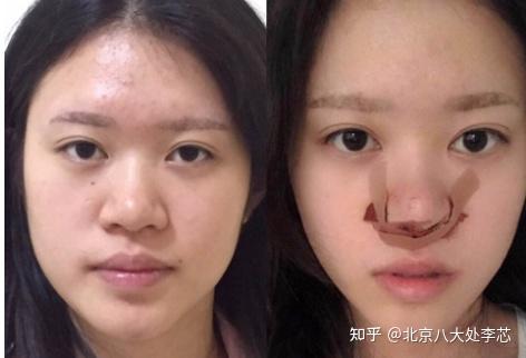 什么类型的人适合单独做鼻头鼻翼缩小,来看看有你吗?