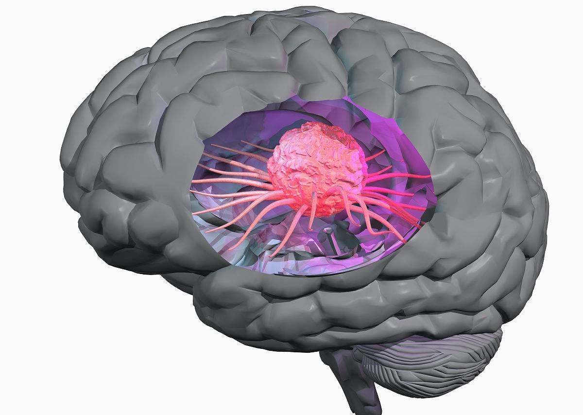 腦瘤手術治療好不好?
