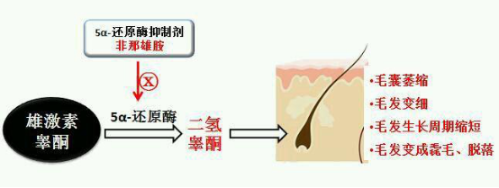 雄激素性脱发原理图片