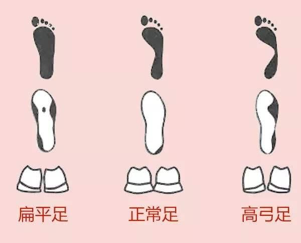 高弓足的潜在危害及注意事项 知乎 高弓足的潜在危害及注意事项 知乎