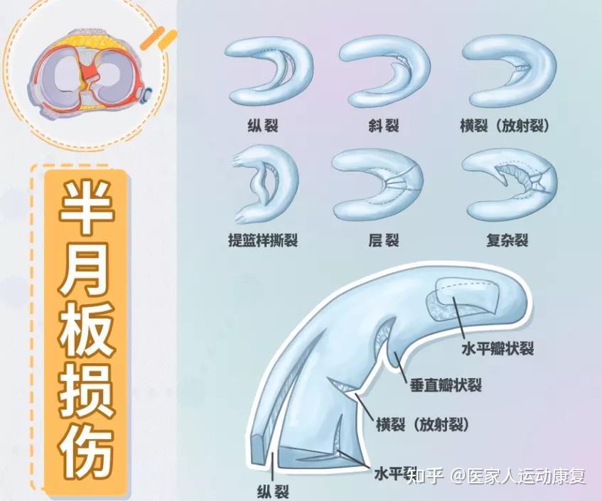 半月板是股骨与胫骨间吸收冲击的软骨类组织.