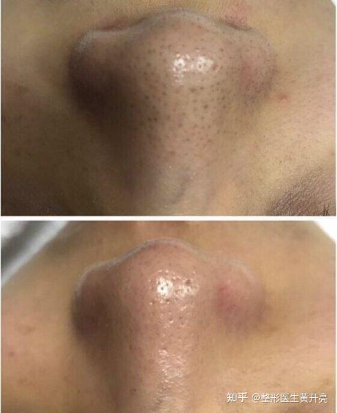 这是黑鼻头吗怎么祛除