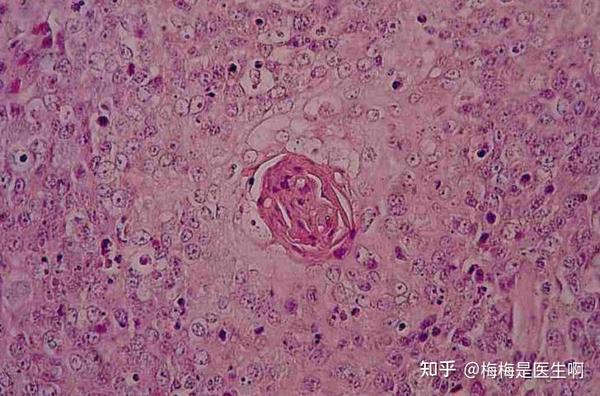 一位退休医生自诊为银屑病手部皮损、溃烂、渗液四十余年，来院检查后 