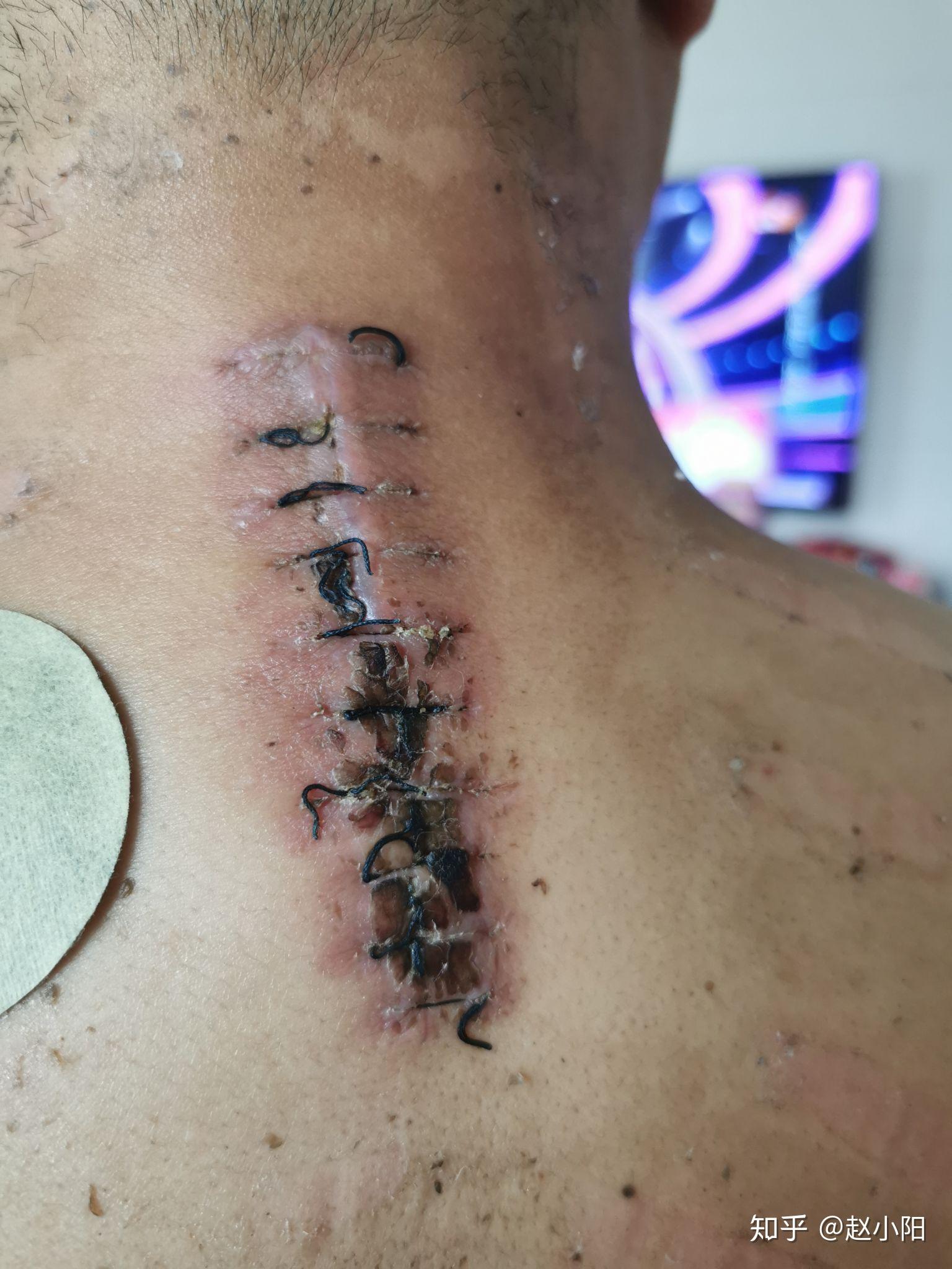 神经鞘瘤颈部第67手术时间2020年6月20日