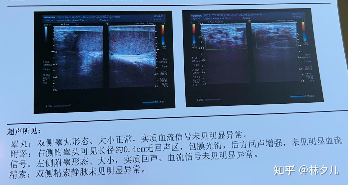 精索静脉曲张一个多月时间再次检查b超完全无异常? - 知乎