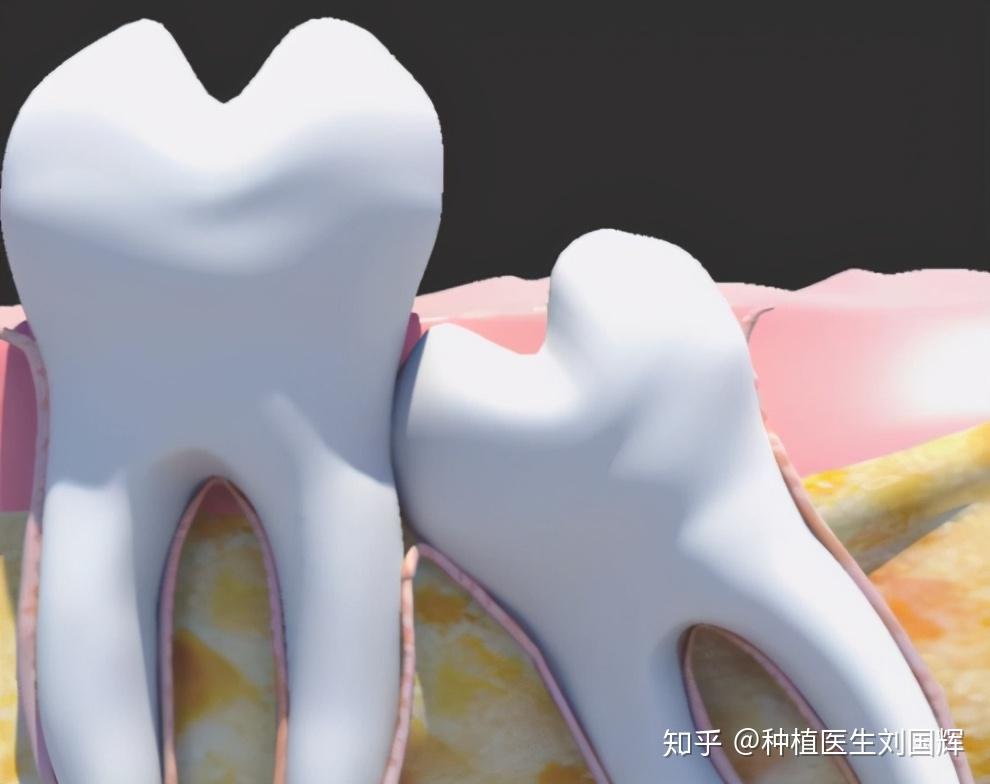 智齒冠周炎也就是智齒髮炎:它可以平淡無奇,消炎即愈,又可以腫脹封喉