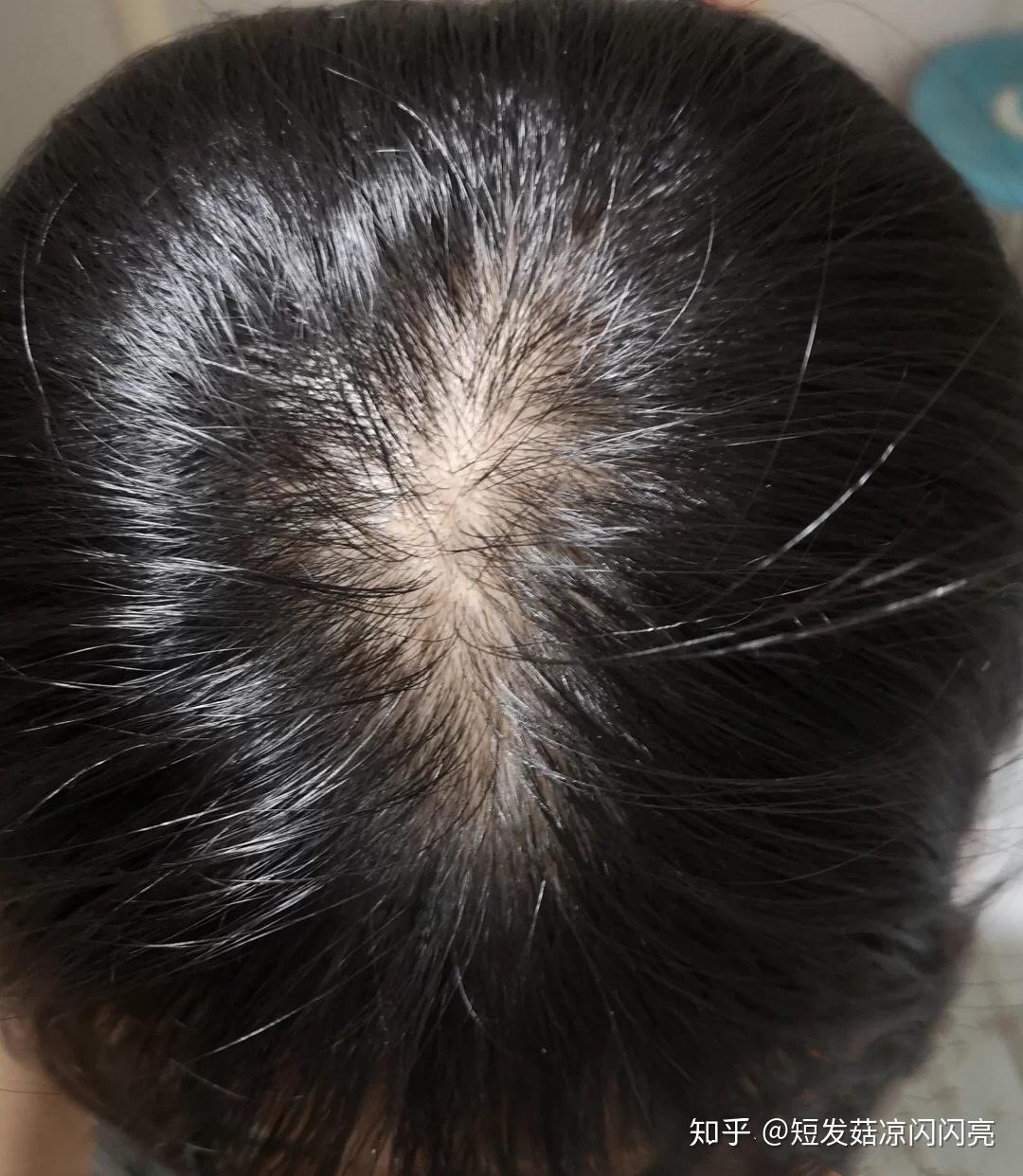 脂溢性脱发有哪些表现特征？ - 知乎
