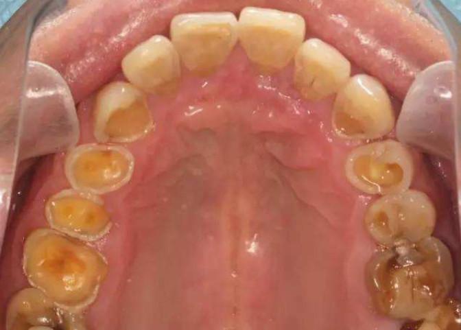 但他们去污的原理都是基于对牙齿的酸蚀效果,他们会带走污渍同时也会