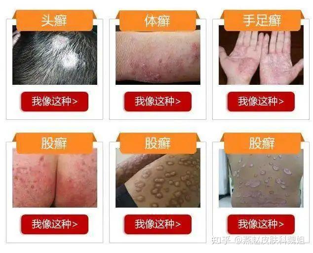 常见的6种皮肤癣类型,你是否曾深受其害?