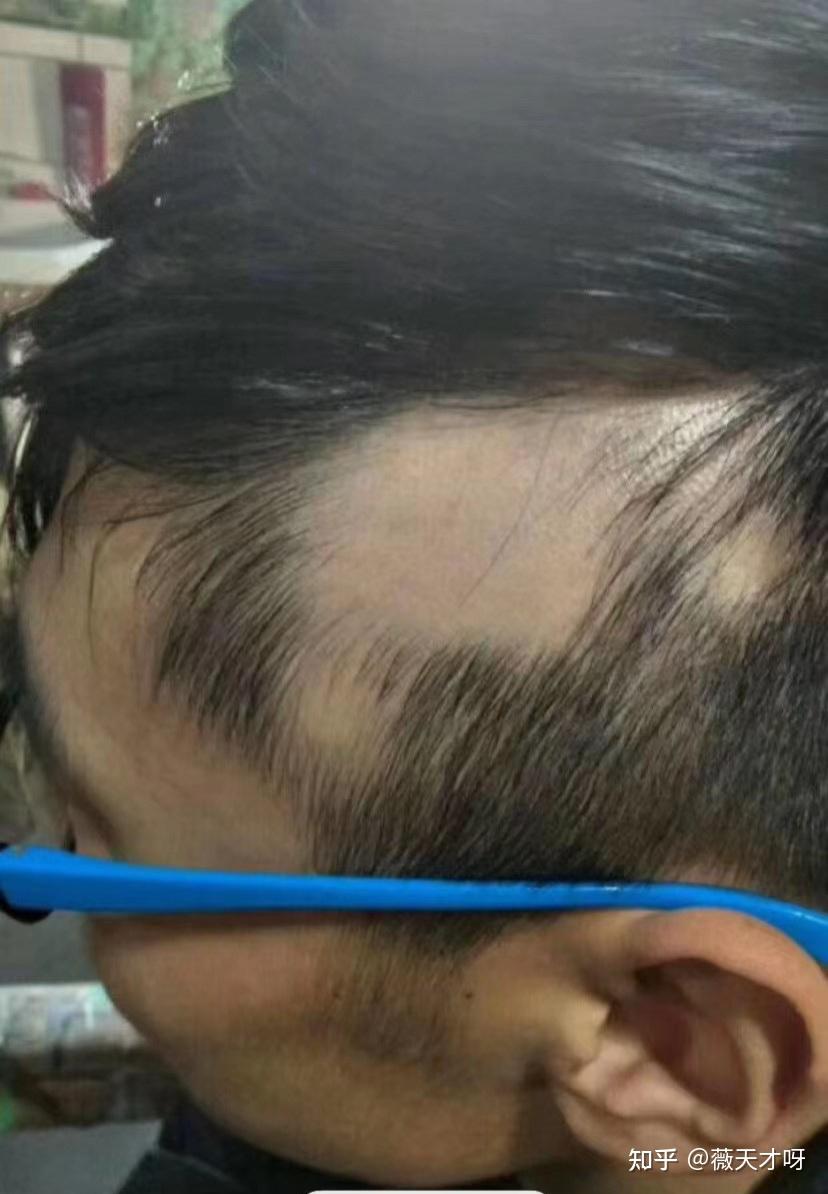 24岁男生斑秃长出头发了
