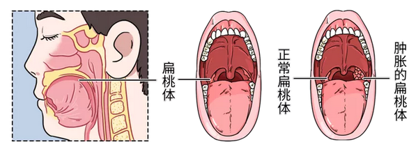 如果脂肪过多导致气管狭窄也会引发张口呼吸 扁桃体,腺样体肥大