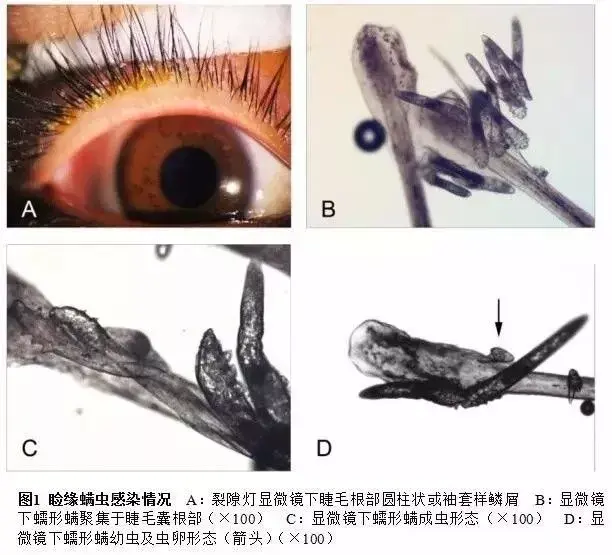 1 患者瞼緣蠕形蟎在光學顯微鏡下的形態蠕形蟎多聚集於睫毛囊根部,蟲