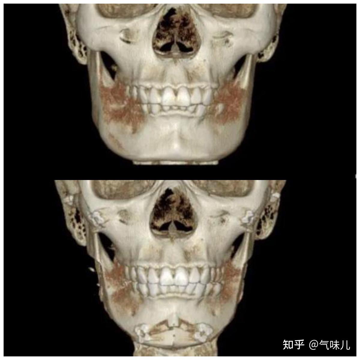方脸削骨过程图图片
