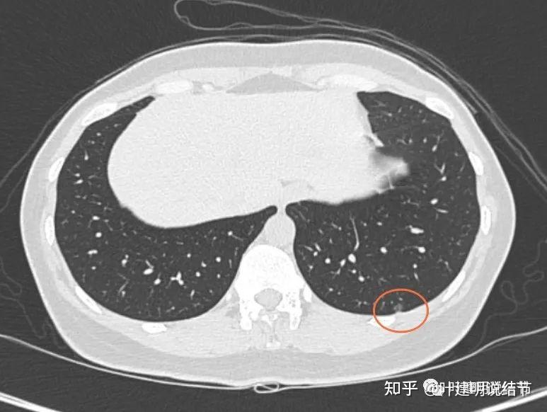 问诊分析20231123多发肺磨玻璃结节的临床决策要有别于孤立性结节操之