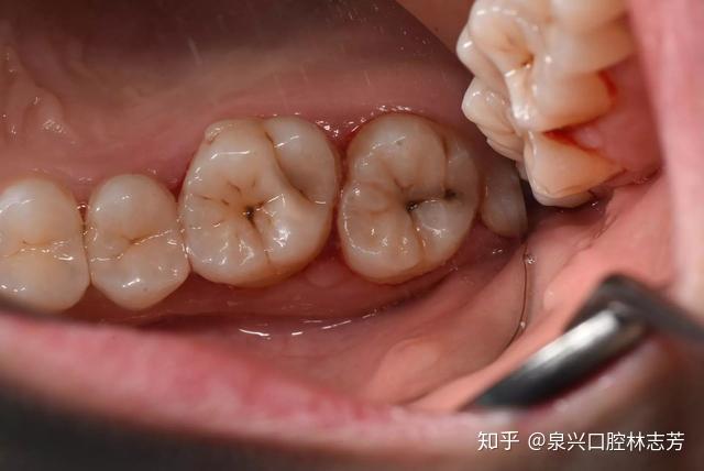 牙齿上小黑点的可怕力量