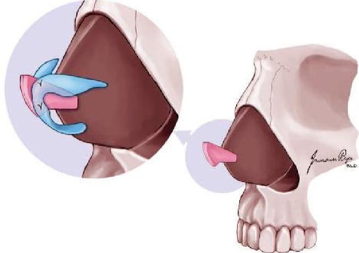 鼻中隔延长术鼻中隔延长术从视觉上来看就是一项拉长鼻子的的手术.