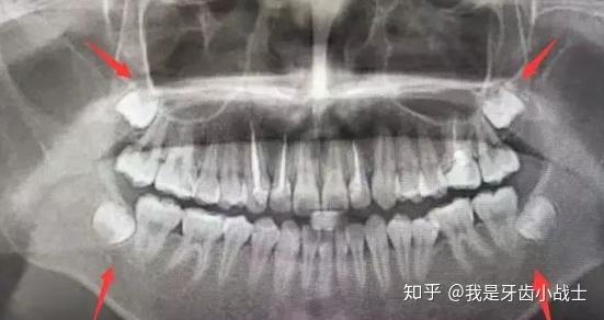智齿是什么时候开始长的 成年后都会长智齿吗 智齿有什么影响 知乎