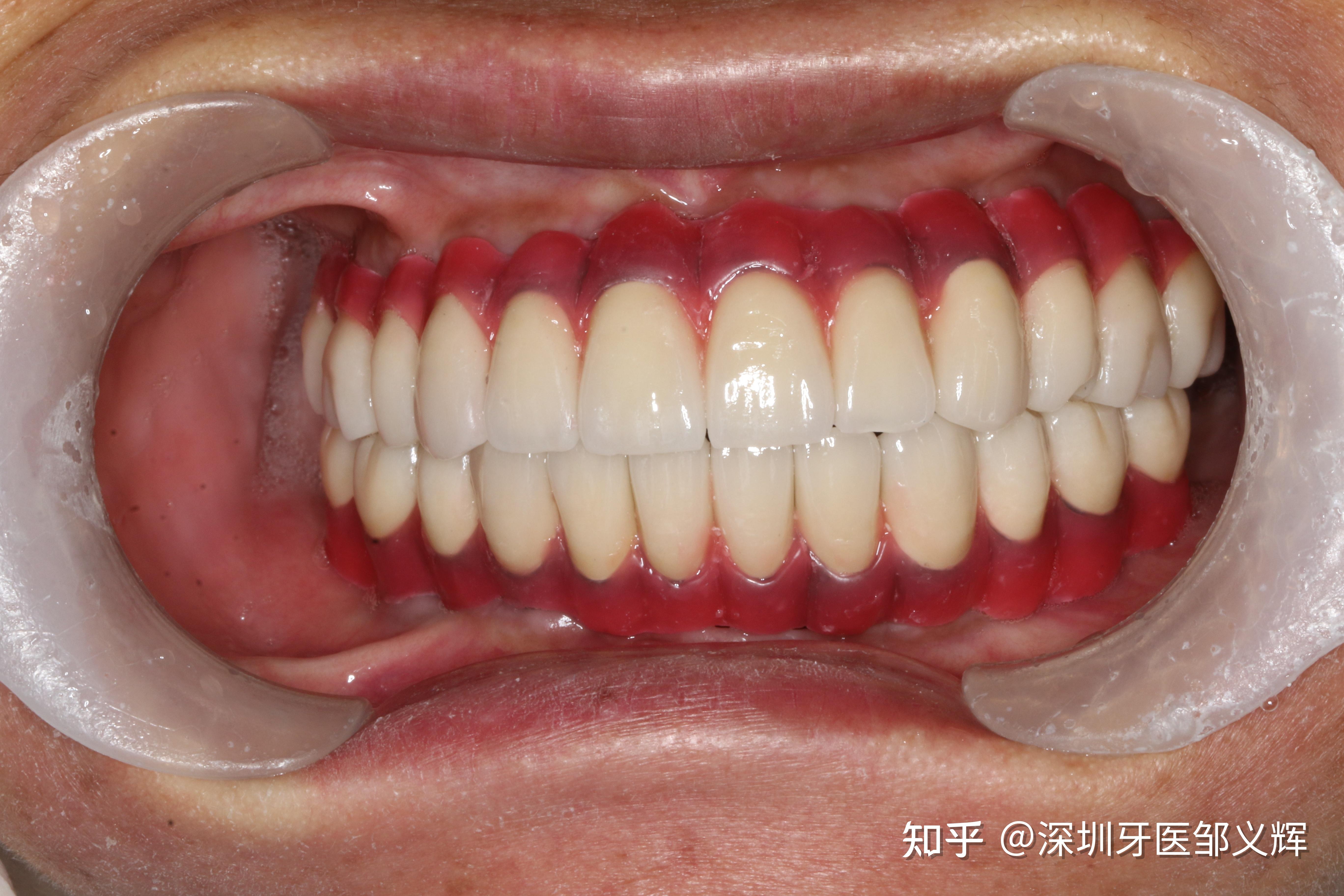 病例分享|天植全口无牙颌修复一例 - 杭州拉瓦生物科技有限公司