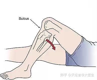 前叉断裂(ACL)小科普 - 知乎