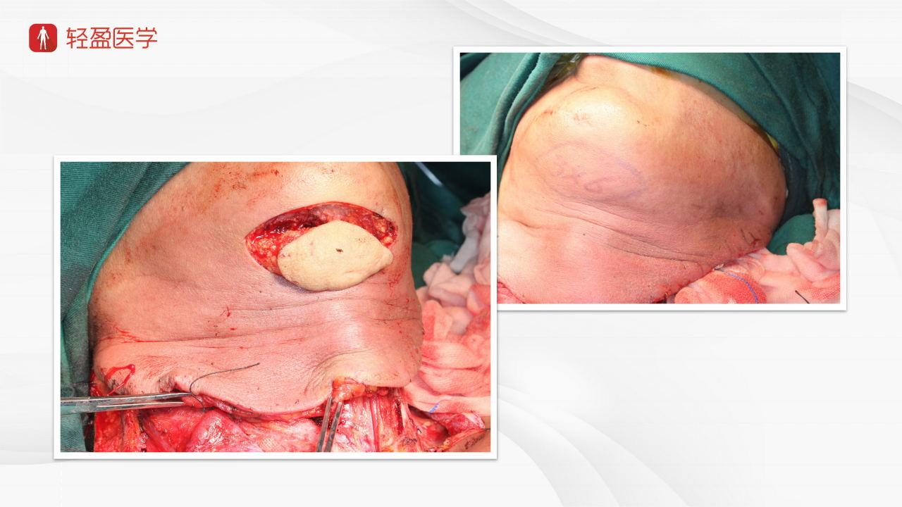 轻盈医学下咽后壁癌伴室性早搏肺气肿的术式详解