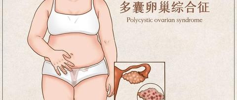 刘兴旺博士话多囊