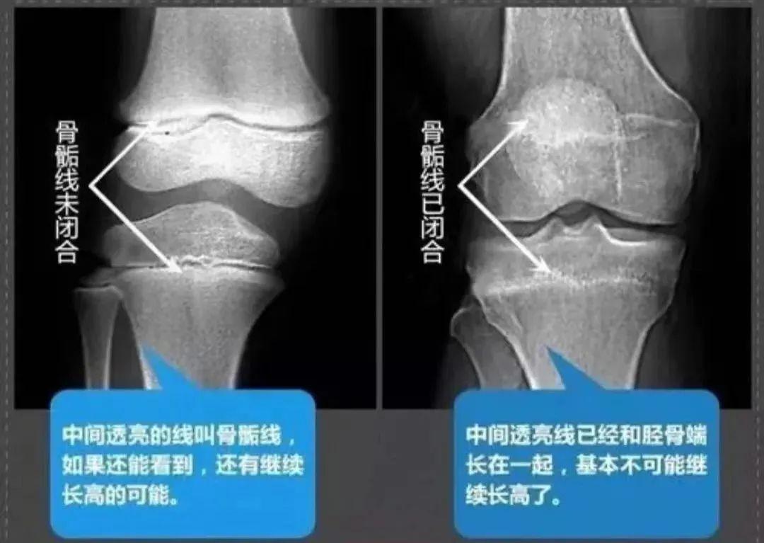 什么是骨骺线？怎么判断骨骺线开始闭合？ - 知乎