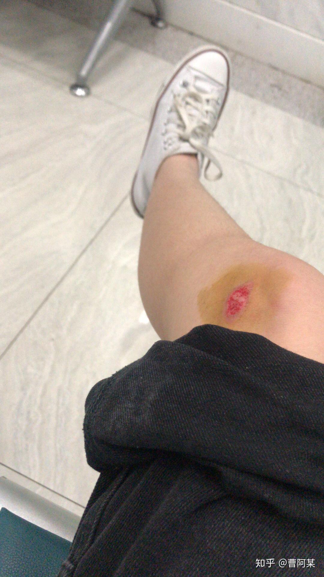 如何在膝盖擦伤不能碰水的情况下洗澡