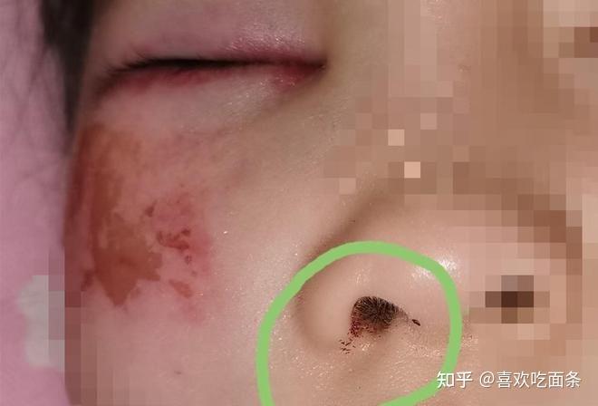 学生算错题遭殴打险失明调查称手误那粉笔强塞鼻孔清洗血迹呢