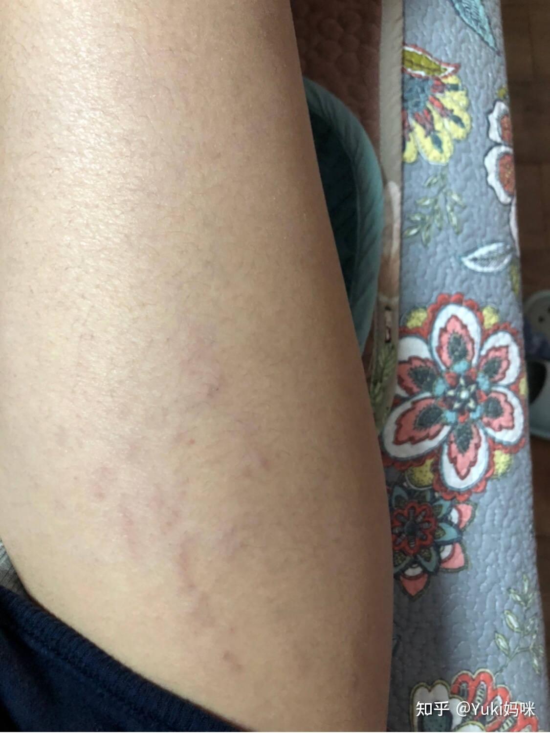 真实肥胖纹淡化分享反馈,不黑不吹,大数据请推给有肥胖纹的姐妹!