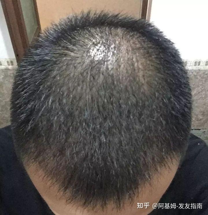 植发能改变显老吗知乎(植发可以改变头发方向吗)