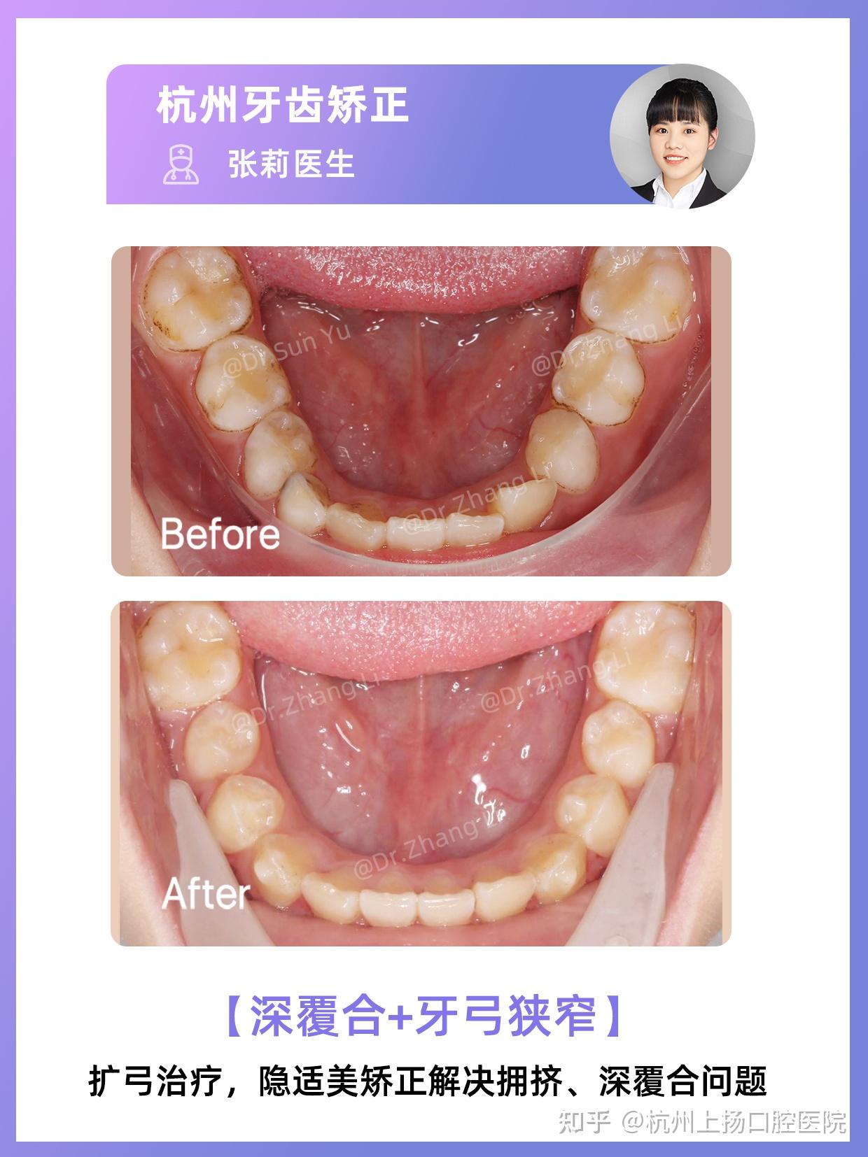 杭州牙齿矫正丨儿童隐适美矫正，见效比较快 - 知乎
