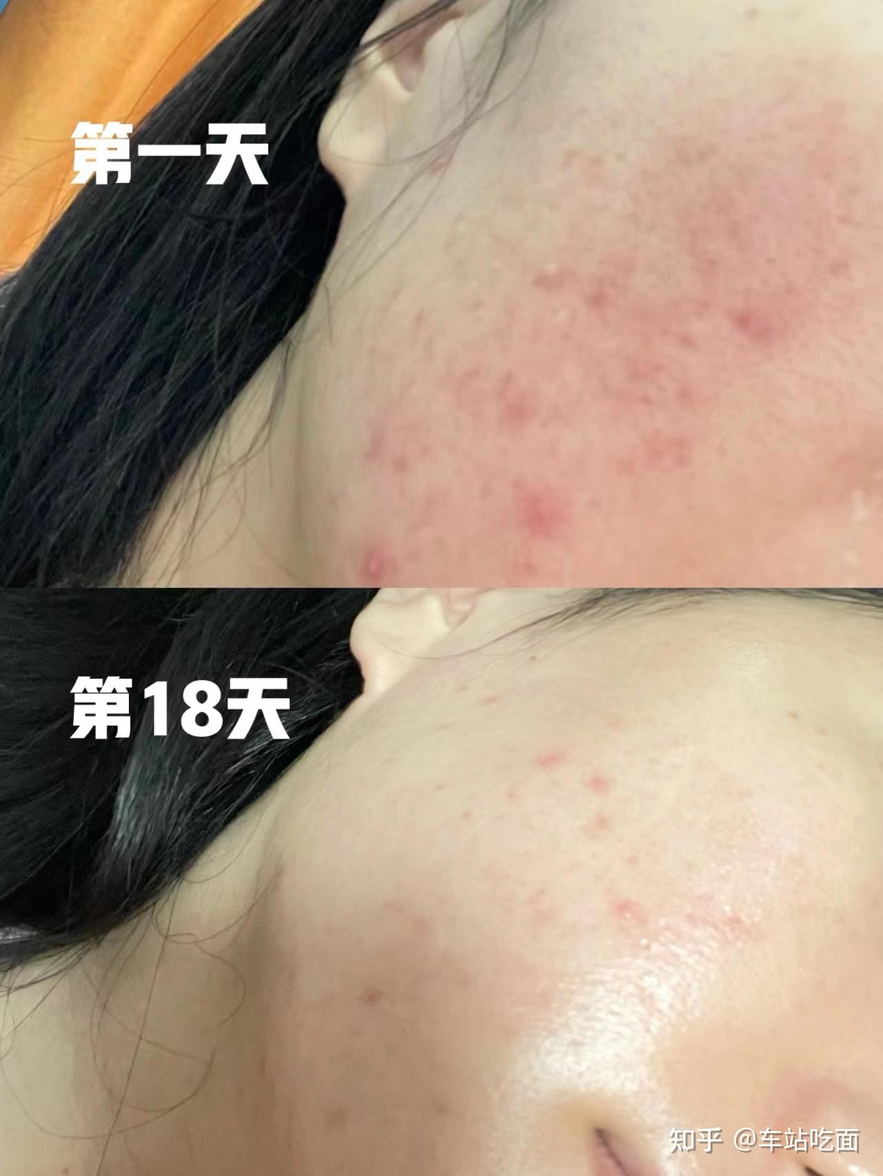 可可缇亚水杨酸祛痘棉片